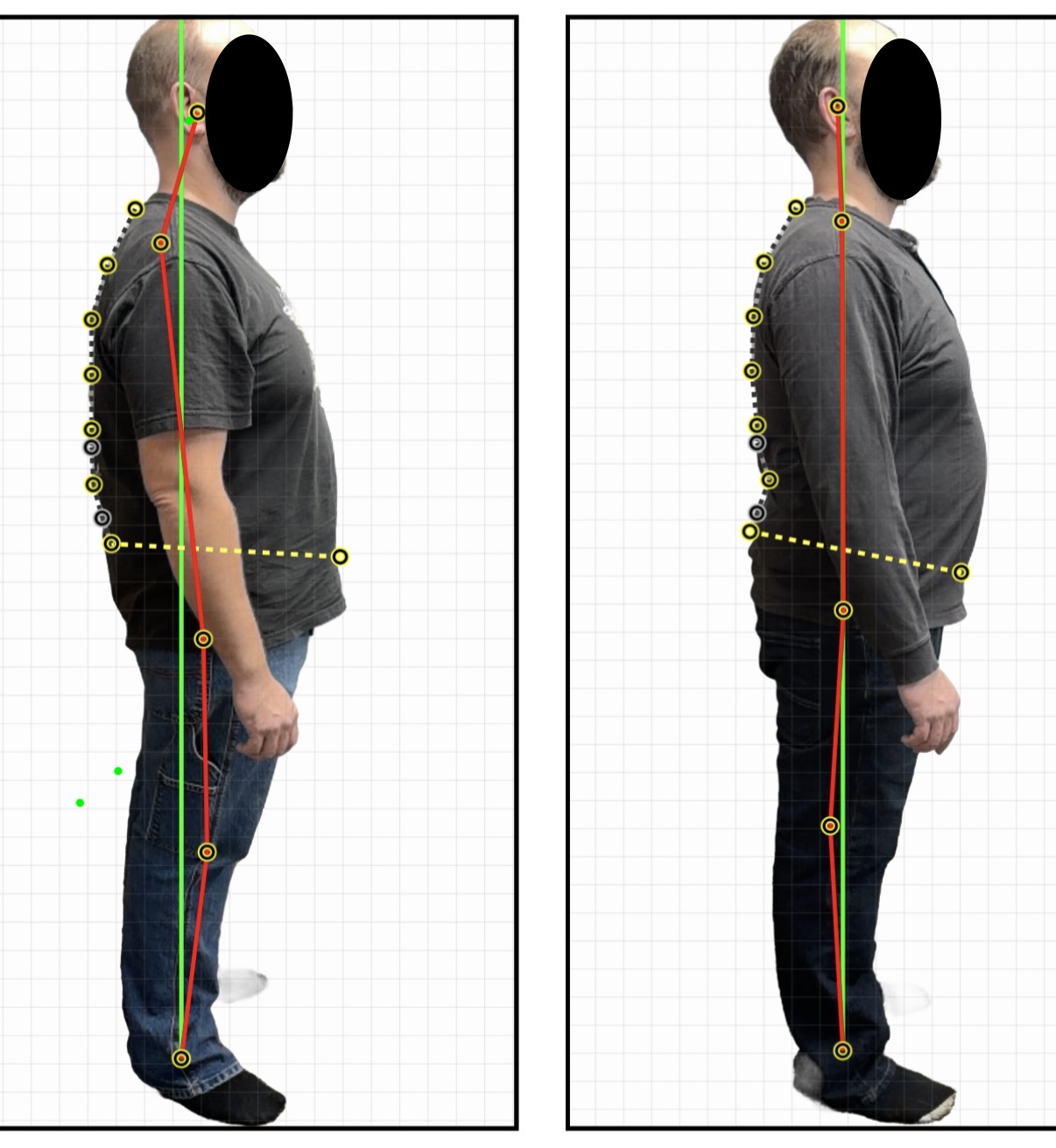 Patient posture before and after structural correction