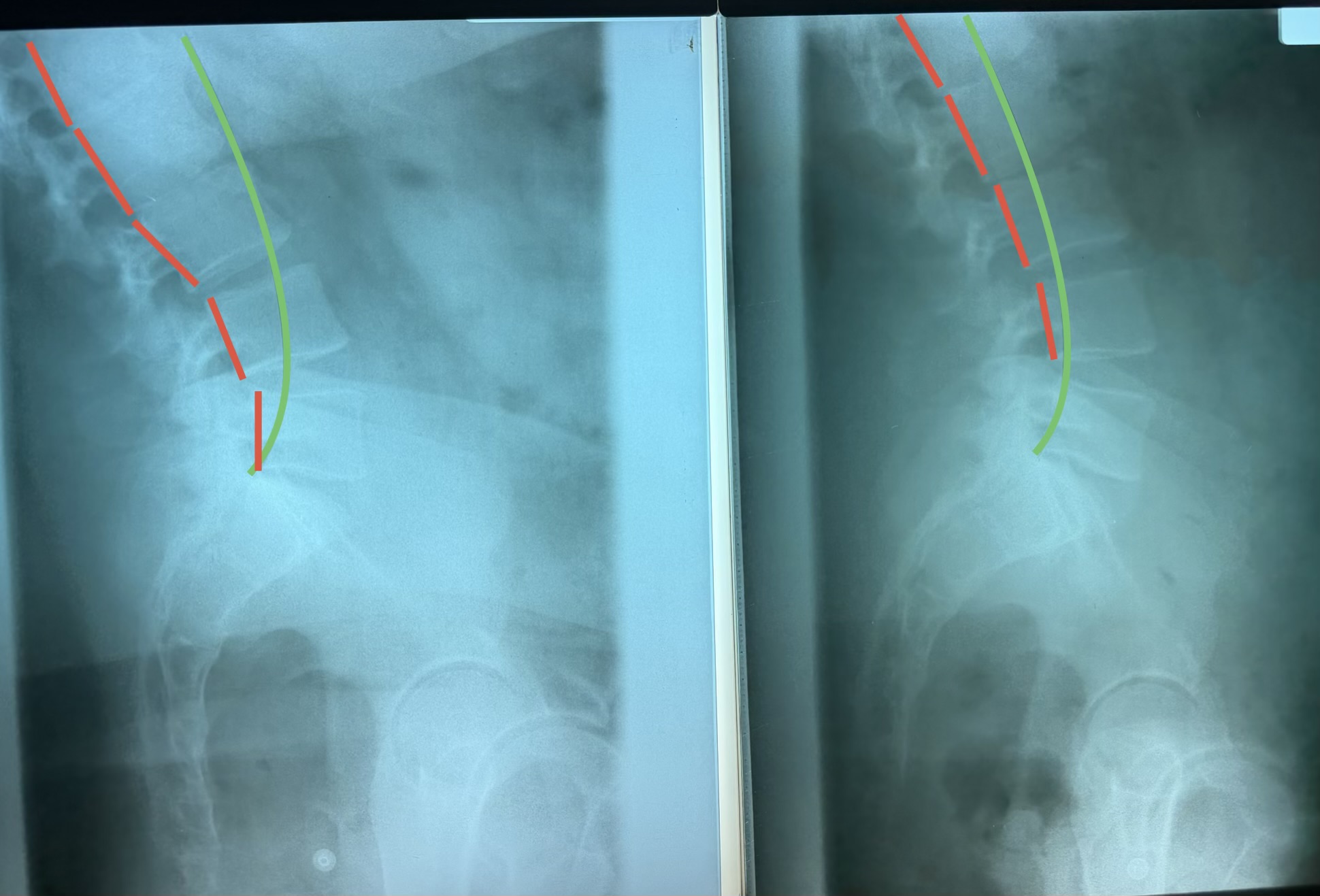 Patient X-ray before and after structural correction